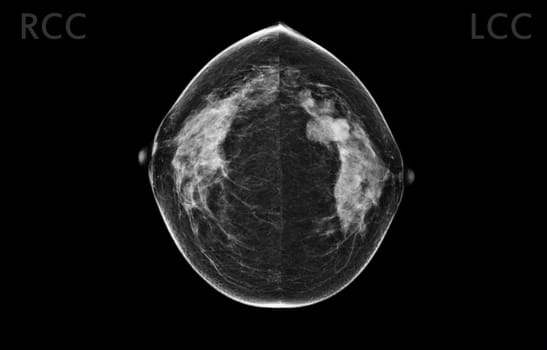 X-ray Digital Mammogram both side CC view . mammography or breast scan for Breast cancer BI-RADS 5; Highly suggestive of malignancy .