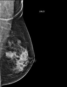 X-ray Digital Mammogram Left side MLO view . mammography or breast scan for Breast cancer BI-RADS 5; Highly suggestive of malignancy .