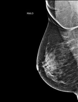 X-ray Digital Mammogram Right side MLO view . mammography or breast scan for Breast cancer BI-RADS 5; Highly suggestive of malignancy .