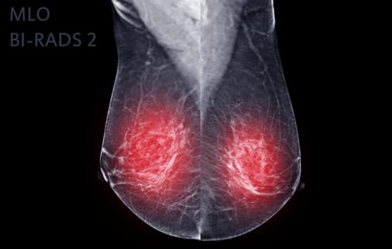 X-ray Digital Mammogram of Right  side  MLO view . mammography or breast scan for Breast cancer  showing BI-RADS CATEGORY 2  Benign tumor.