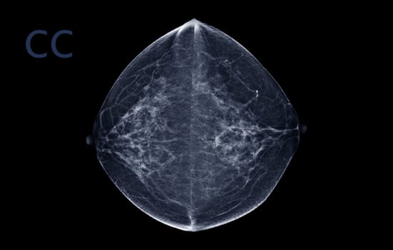  X-ray Digital Mammogram of Both  side  CC view . mammography or breast scan for Breast cancer  showing BI-RADS CATEGORY 2  Benign tumor.