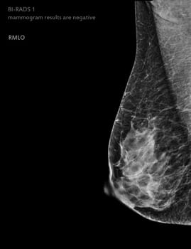  X-ray Digital Mammogram left side MLO view . mammography or breast scan for Breast cancer BI-RADS 1 mammogram results are negative.