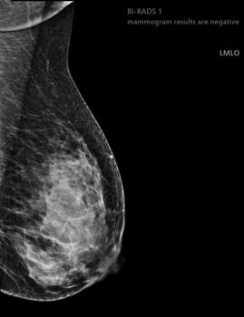  X-ray Digital Mammogram Right side MLO view . mammography or breast scan for Breast cancer BI-RADS 1 mammogram results are negative.