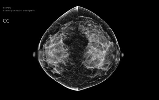  X-ray Digital Mammogram of both side CC view . mammography or breast scan for Breast cancer BI-RADS 1 mammogram results are negative.