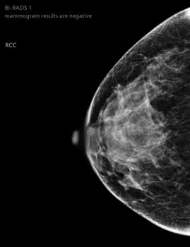  X-ray Digital Mammogram Right side CC view . mammography or breast scan for Breast cancer BI-RADS 1 mammogram results are negative.