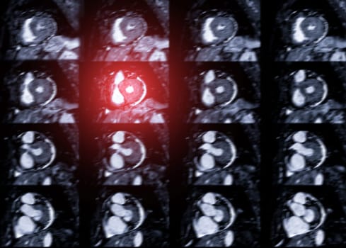 MRI heart or Cardiac MRI ( magnetic resonance imaging ) of heart for diagnosis heart disease.