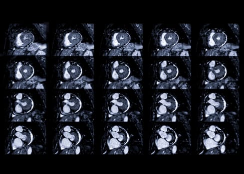 MRI heart or Cardiac MRI ( magnetic resonance imaging ) of heart for diagnosis heart disease.