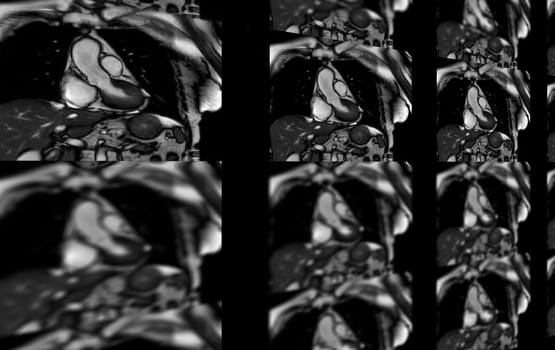 MRI heart or Cardiac MRI ( magnetic resonance imaging ) of heart for diagnosis heart disease.