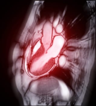 MRI heart or Cardiac MRI ( magnetic resonance imaging ) of heart for diagnosis heart disease.