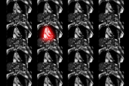 MRI heart or Cardiac MRI ( magnetic resonance imaging ) of heart for diagnosis heart disease.