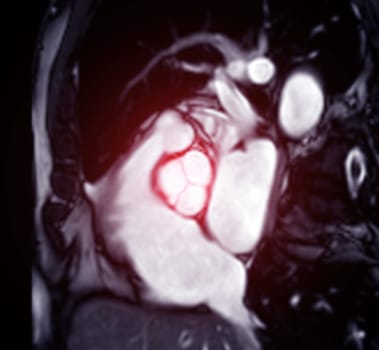 MRI heart or Cardiac MRI ( magnetic resonance imaging ) of heart for diagnosis heart disease.