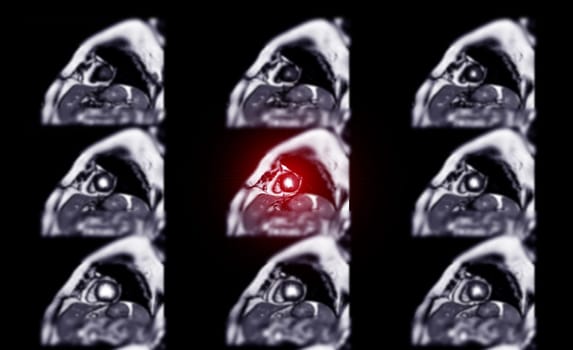 MRI heart or Cardiac MRI ( magnetic resonance imaging ) of heart for diagnosis heart disease.