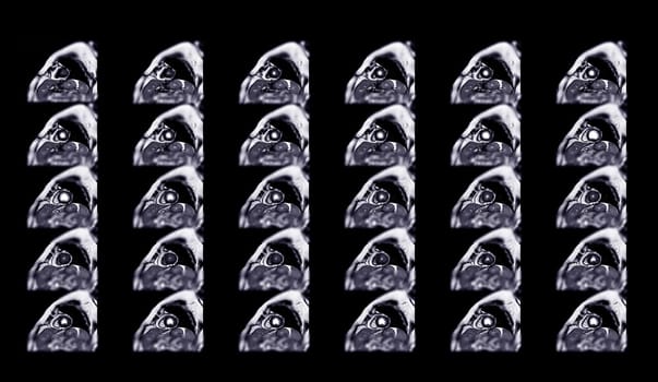 MRI heart or Cardiac MRI ( magnetic resonance imaging ) of heart for diagnosis heart disease.