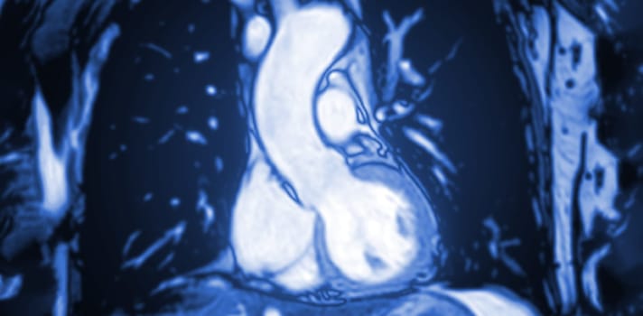 MRI heart or Cardiac MRI ( magnetic resonance imaging ) of heart for diagnosis heart disease.