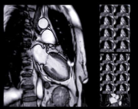 MRI heart or Cardiac MRI ( magnetic resonance imaging ) of heart for diagnosis heart disease.