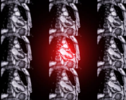 MRI heart or Cardiac MRI ( magnetic resonance imaging ) of heart for diagnosis heart disease.