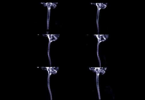 MRI of  C-spine or magnetic resonance image of cervical spine sagittal view  for diagnosis spondylosis causing cervical spondylotic myelopathy and compression fracture.