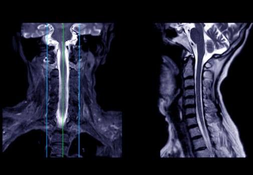 MRI of  C-spine or magnetic resonance image of cervical spine sagittal view  for diagnosis spondylosis causing cervical spondylotic myelopathy and compression fracture.