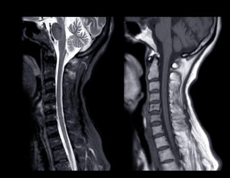 MRI of  C-spine or magnetic resonance image of cervical spine sagittal view  for diagnosis spondylosis causing cervical spondylotic myelopathy and compression fracture.