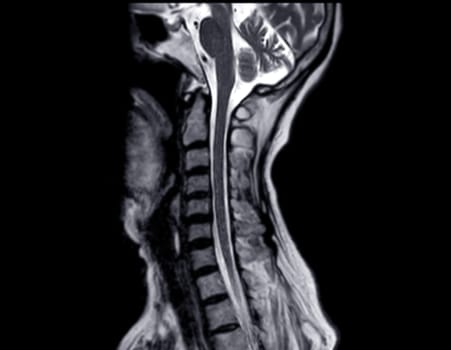 MRI of  C-spine or magnetic resonance image of cervical spine sagittal view  for diagnosis spondylosis causing cervical spondylotic myelopathy and compression fracture.