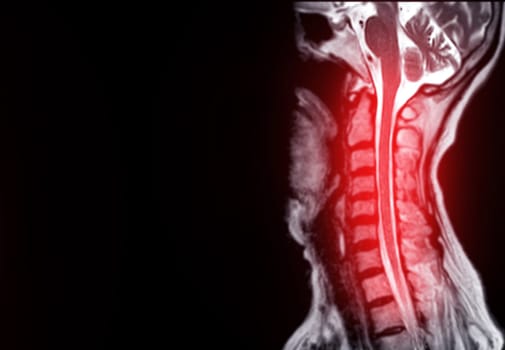 MRI of  C-spine or magnetic resonance image of cervical spine sagittal view  for diagnosis spondylosis causing cervical spondylotic myelopathy and compression fracture.