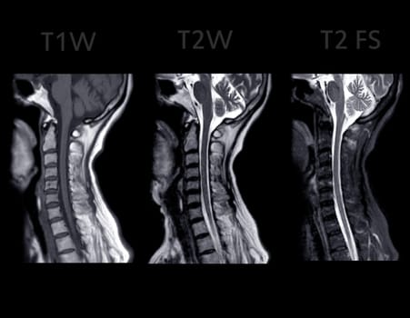 MRI of  C-spine or magnetic resonance image of cervical spine sagittal view  for diagnosis spondylosis causing cervical spondylotic myelopathy and compression fracture.