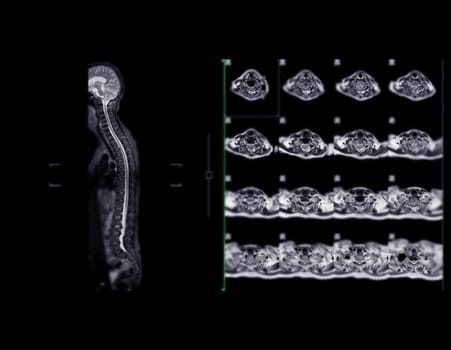 MRI whole spine screening for diagnosis spinal cord compression.