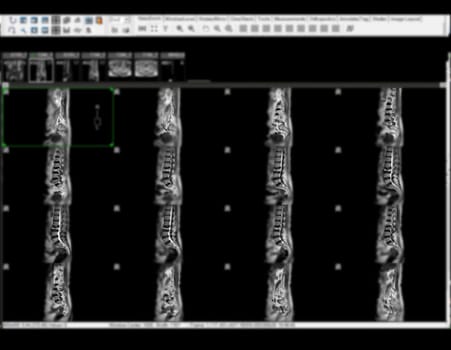 MRI L-S spine or lumbar spine sagittal view for diagnosis spinal cord compression.