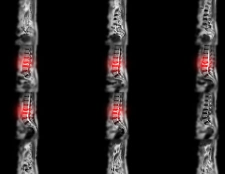 MRI L-S spine or lumbar spine for diagnosis spinal cord compression.