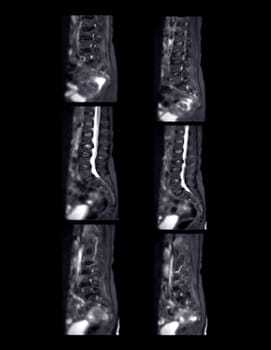 MRI L-S spine or lumbar spine for diagnosis spinal cord compression.
