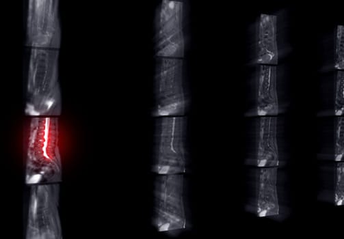 MRI L-S spine or lumbar spine for diagnosis spinal cord compression.