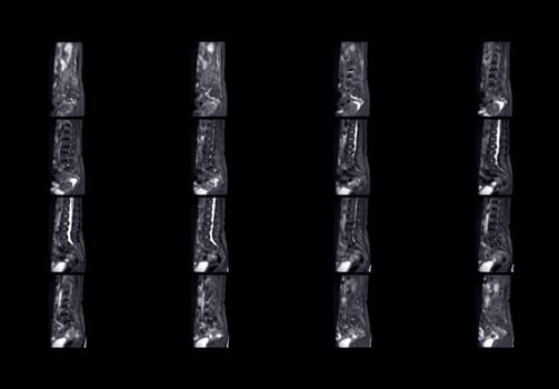 MRI L-S spine or lumbar spine for diagnosis spinal cord compression.