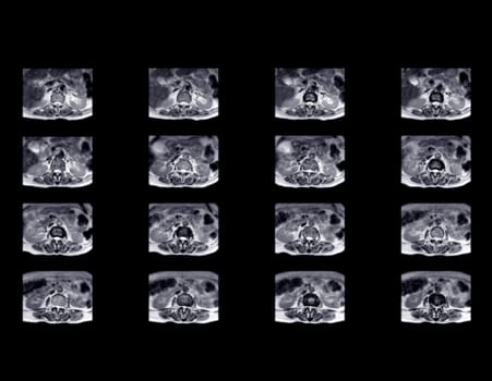 MRI L-S spine or lumbar spine for diagnosis spinal cord compression.