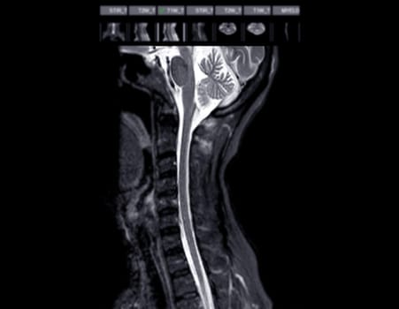 MRI of  C-spine or magnetic resonance image of cervical spine sagittal view  for diagnosis spondylosis causing cervical spondylotic myelopathy and compression fracture.