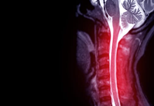 MRI of  C-spine or magnetic resonance image of cervical spine sagittal view  for diagnosis spondylosis causing cervical spondylotic myelopathy and compression fracture.