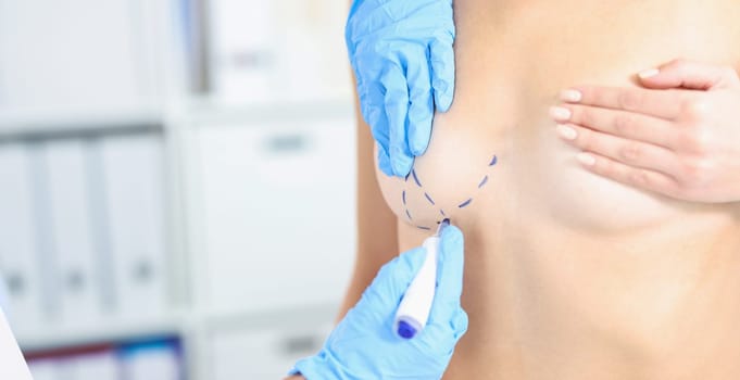 Close-up of doctor making marking on boob for future cosmetic surgery operation. Preparation for surgery. Plastic surgery, medicine concept