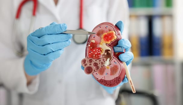 Close-up of urologist pointing pen kidney structure on anatomical model. Treatment of kidney diseases, pyelonephritis
