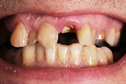 Crooked teeth in the mouth. Orthodontics. Malocclusion. Dental disease, unkempt teeth. Dental problems.