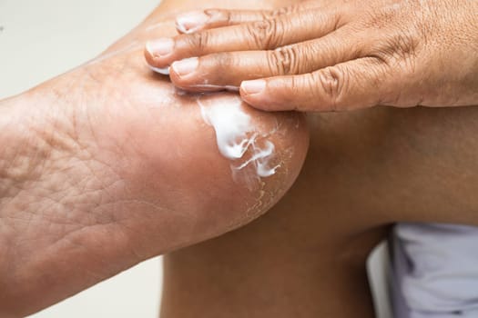 Woman care feet with cracked and dry heel skin cream at home.
