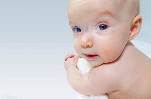 a baby with a hemangioma on his neck lies on a white background. banner with a copy space. profile of a little bald baby girl. the kid looks to the side