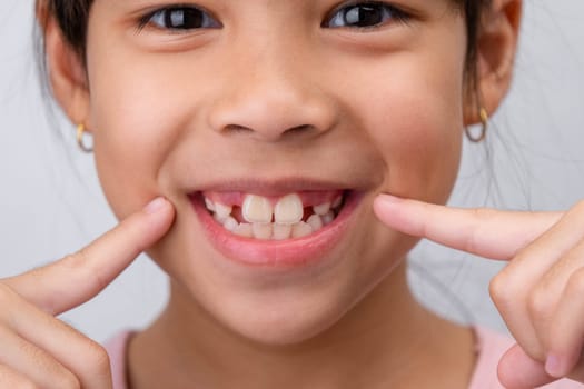 Close-up of cute young girl smiling wide, showing empty space with growing first front teeth. Little girl with big smile and missing milk teeth. Dental hygiene concept