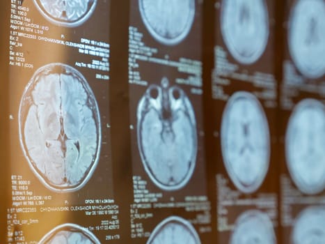 MRI of the human brain of a patient with multiple sclerosis of the initial stage. Close-up X-ray