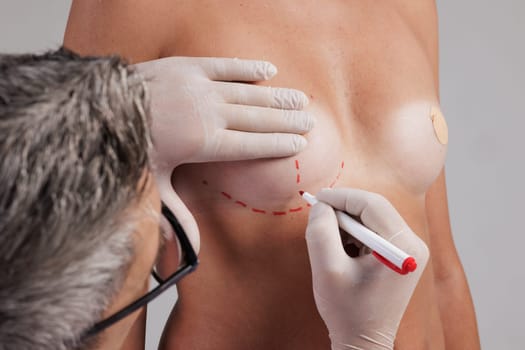 A plastic surgeon applies markings with a red marker before breast augmentation surgery, mammoplasty, concept beautiful breast shape