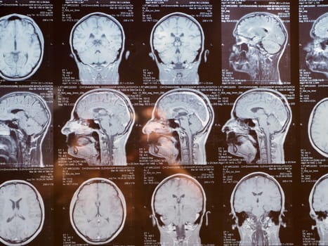 MRI of the human brain of a patient with multiple sclerosis of the initial stage. Close-up X-ray