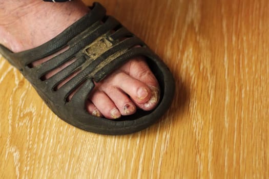 A foot with noticeable signs of toe disease is shown in a scandal, revealing discolored and damaged toenails