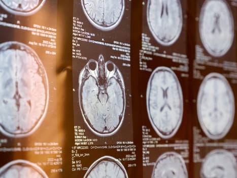 MRI of the human brain of a patient with multiple sclerosis of the initial stage. Close-up X-ray