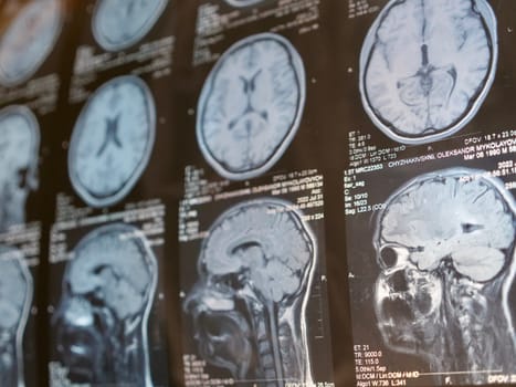 MRI of the human brain of a patient with multiple sclerosis of the initial stage. Close-up X-ray