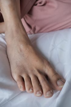 close up of women feet with swelling .