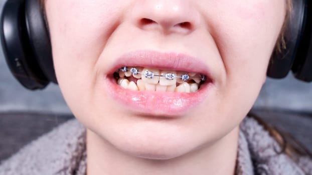 Happy smiling teenage girl with dental braces. Orthodontic treatment