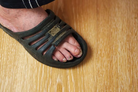 Close-up of a foot with visible toe disease while wearing a sandal on wooden floor indoors